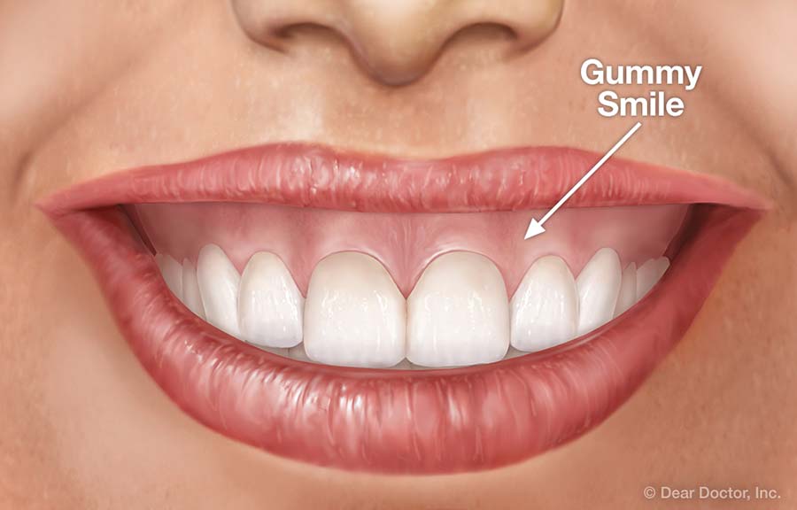 Gummy Smile.
